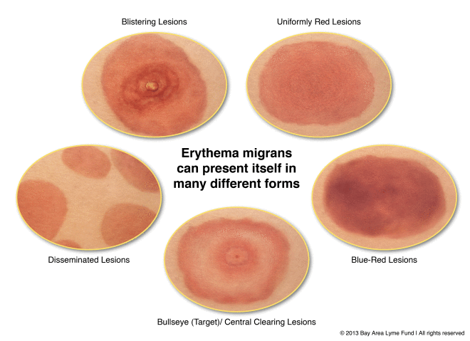 Different forms of tick bite rashes