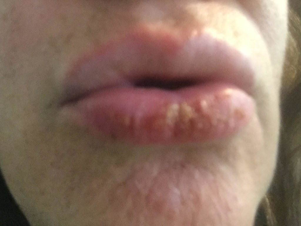 Doxy side effects: blistered lips from sun poisoning
