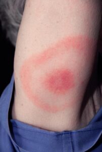 Classic Lyme Disease Erythema Migrans Bull's-Eye Rash