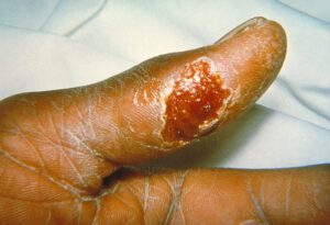Tularemia ulcer: one of many tick bite rashes