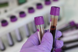 How the Lyme Disease Test Failed Me