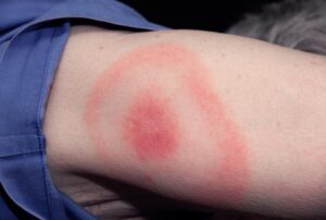 Tick Bite Rash: A Blessing in Disguise